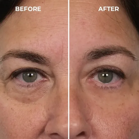 Before and after photos of a guest's eye area