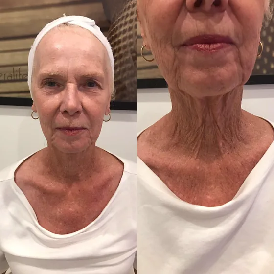 A guest before treatment, and a close-up of her neck