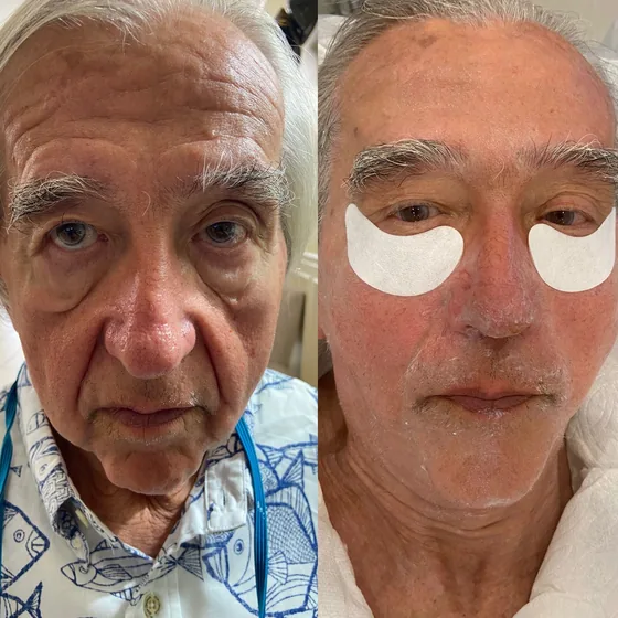 A guest before treatment, and during treatment with under-eye patches